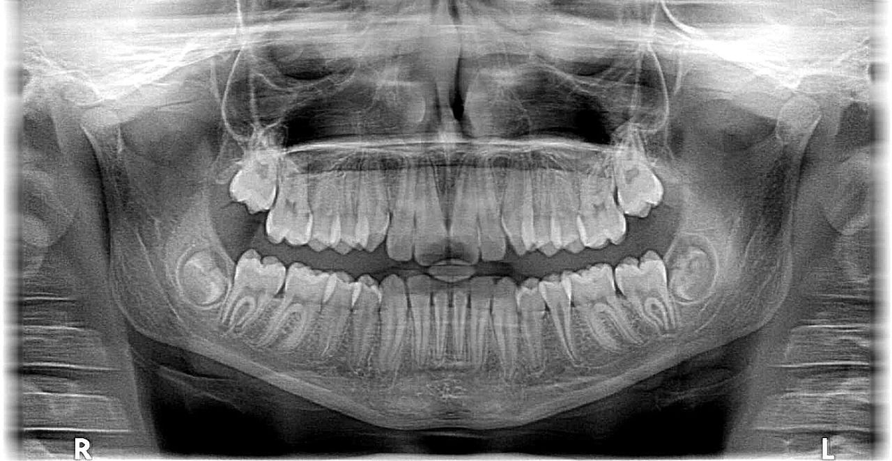 W jakim celu jest wykonywany rentgen zęba?